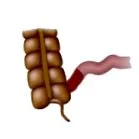 crohn sănătate