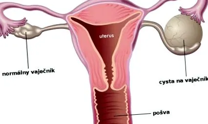 ovarian ovarian