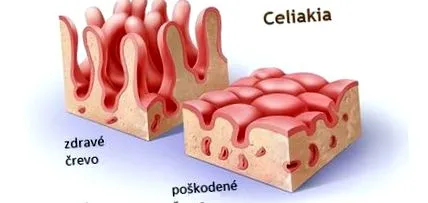 celiacă boala