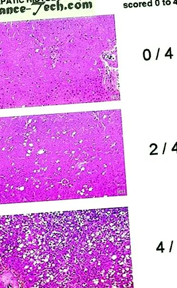 steatoza parenterale