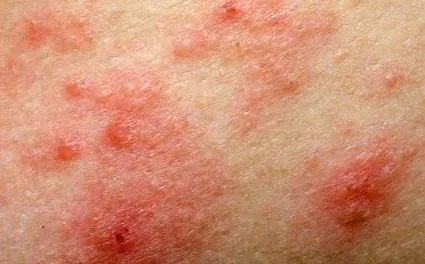 eczema