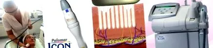 piele laser
