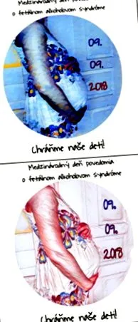 sindromului
