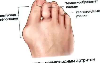 artrită acid uric