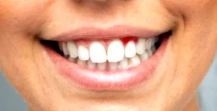 umflate