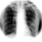 pulmonară