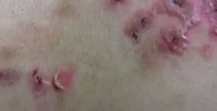 pemphigus