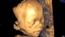 diagnostic prenatal