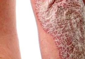 simptome psoriazisului
