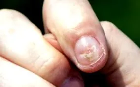 psoriazis psoriazis