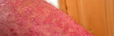 asociate psoriazis