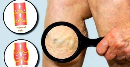 simptomele acesteia