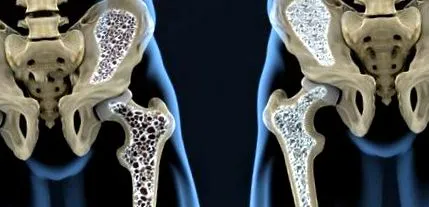 prevenirea osteoporozei prevenirea