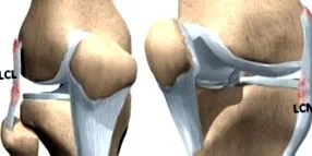 ligamentitis