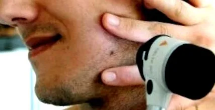 carcinoame celule melanomul