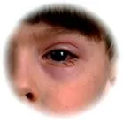 portál gyulladása