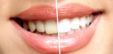 dent32