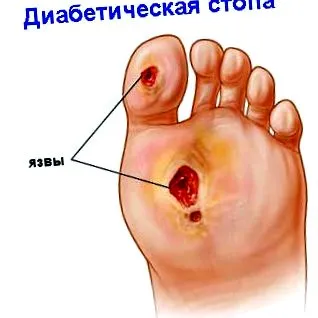 piciorului