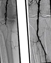 endovascular sanatate