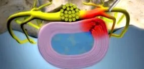 plăcilor endoscopică