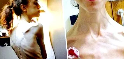 anorexice