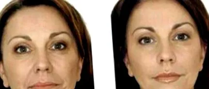 facelift energetic
