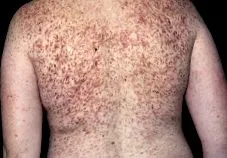 mastocitoza