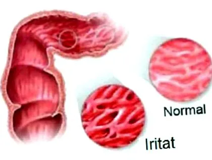 irritált tiltott