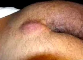 pilonidal