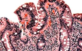 celiac enteropathia