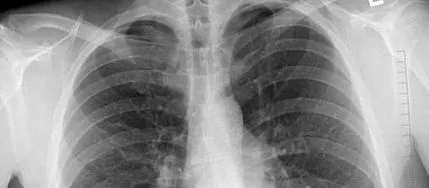 bronchoscopy