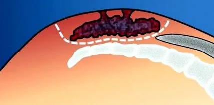 pilonidal
