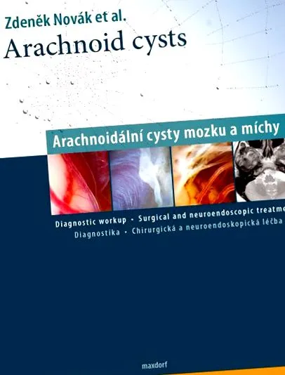 arachnoid ciszták