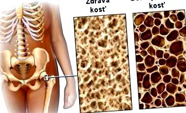 osteoporoza