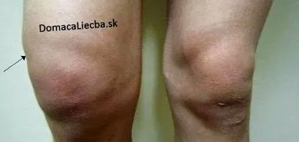 коляното