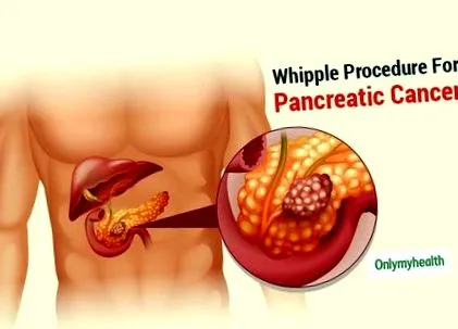 flagelilor pancreatic