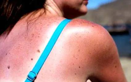 prevenirea arsurilor