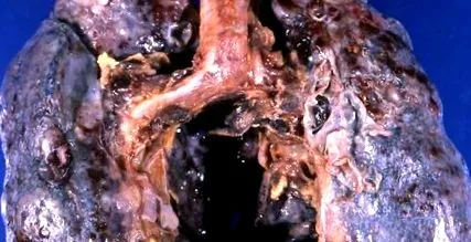 pulmonar