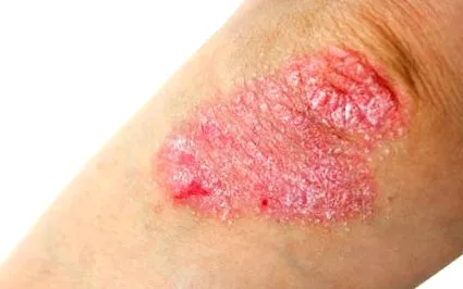 psoriazis