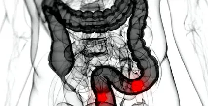 colon cancerul