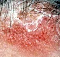 dermatita