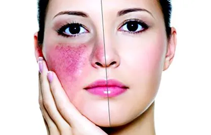 rosacea
