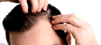 șampon dermatita