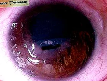 încălzirea corneei