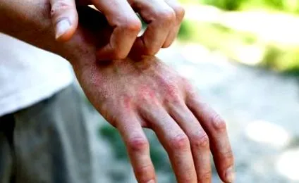 atopică eczemă
