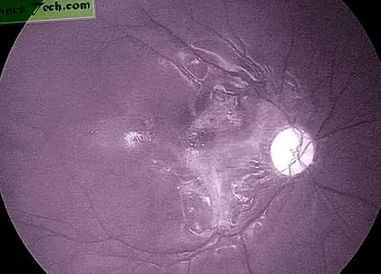 hemoragii nistagmus