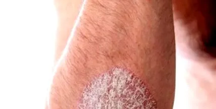 psoriazis