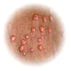 xanthoma Sănătate prevenire