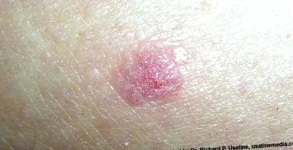 melanoma
