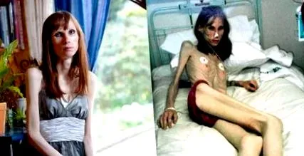 corpul anorexia
